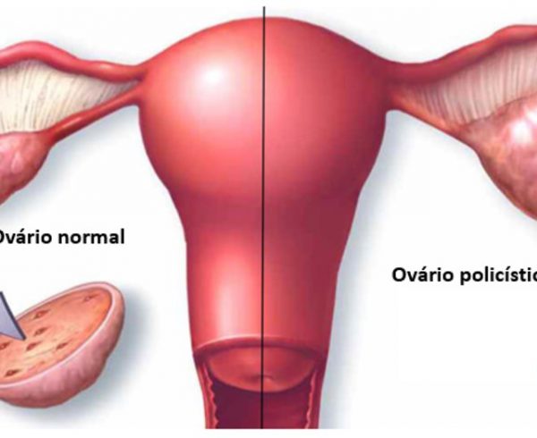 Endometriose, SOP, TPM e Problemas Menstruais: Conheça Uma Possível Solução
